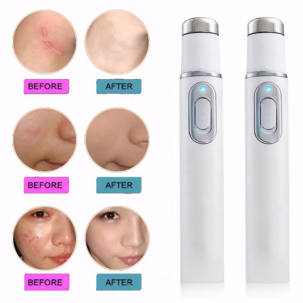 Mavi Işık Terapisi Akne Kalemi - Acne Light Therapy Pen incelemesi ve fiyatı